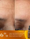 Before and after images showing reduced wrinkles on a forehead using Vitamin C serum.