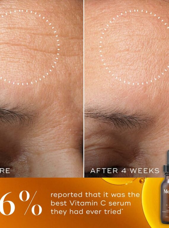 Before and after images showing reduced wrinkles on a forehead using Vitamin C serum.