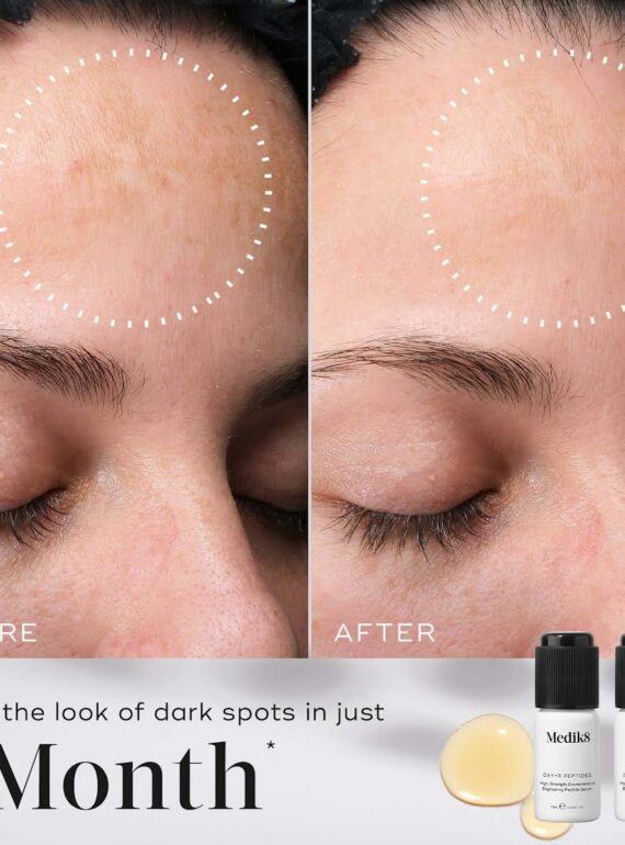 Before and after photo showing improved skin texture after 1 month of using a skincare product.