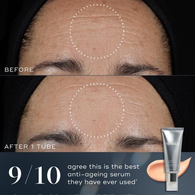 Before and after images showing reduced forehead wrinkles with a skincare product.