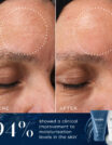 Before and after images show significant reduction in forehead wrinkles using a skincare product.