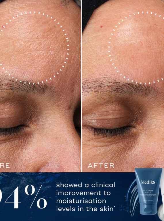 Before and after images show significant reduction in forehead wrinkles using a skincare product.